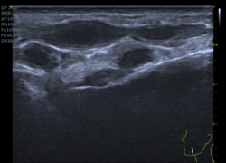 ultrasound filler excess